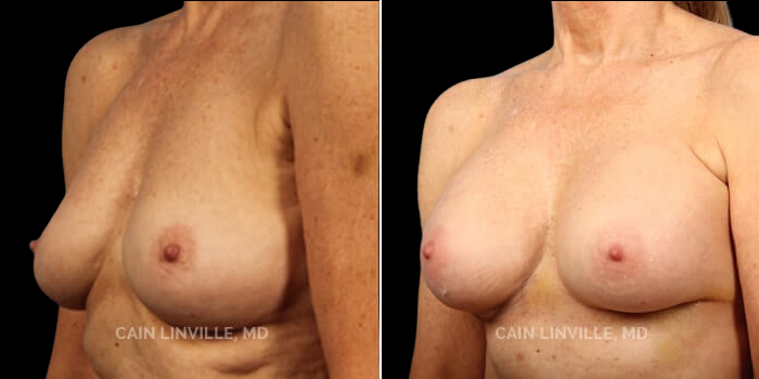Patient 10 3/4th Left Side View Breast Augmentation Linville Plastic Surgery