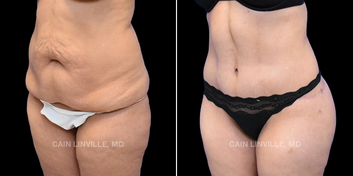 37 y/o female 4 months post-op: Tummy tuck Lipo to the abdomen, flanks, bra line, and back Bodytite to back of thighs Fat grafting to buttocks