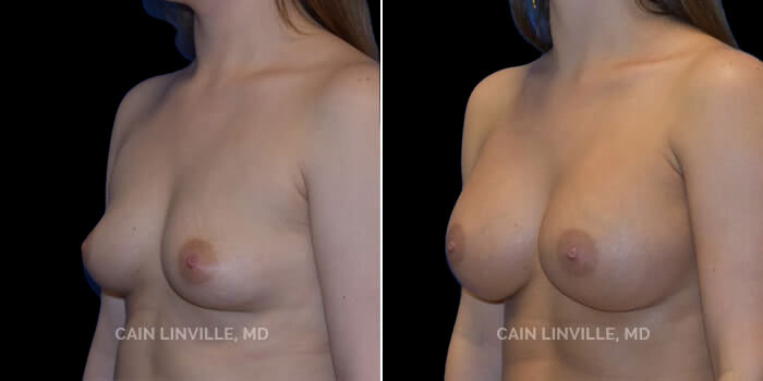 This young woman desired a size that fit her body but wanted a full round look with upper pole cleavage. She wanted to be a full C or D cup. 420 cc gummy bear implant, dual plane 0.5 pocket, inframammary incision. She has a very natural shape with no obvious scar, and a definite increase in her breast volume and a nice round shape to the upper pole of her breast.