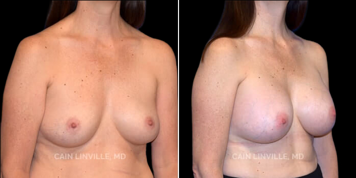 Patient 12 3/4th Right Side View Breast Augmentation Linville Plastic Surgery