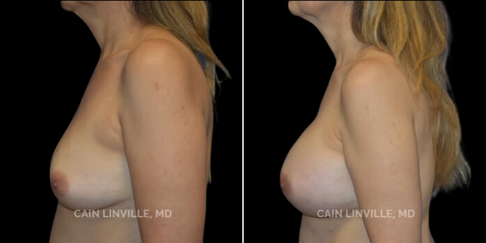 Patient 13 Left Side View Breast Augmentation Linville Plastic Surgery