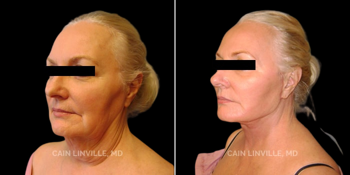 Patient 01 3/4th Left View Face and Neck Lift Linville Plastic Surgery