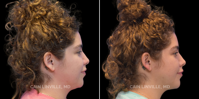 This patient is a 29-year-old female who wanted to achieve a natural-looking jawline using facetite and submental liposuction. These photos are 8 months post-op.