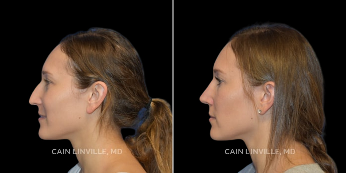 Patient 01 Right View Rhinoplasty Linville Plastic Surgery