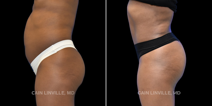 55 yr old underwent tummy tuck with hernia repair along with Brazilian butt lift. Injected 300 cc to each side to improve projection and shape.