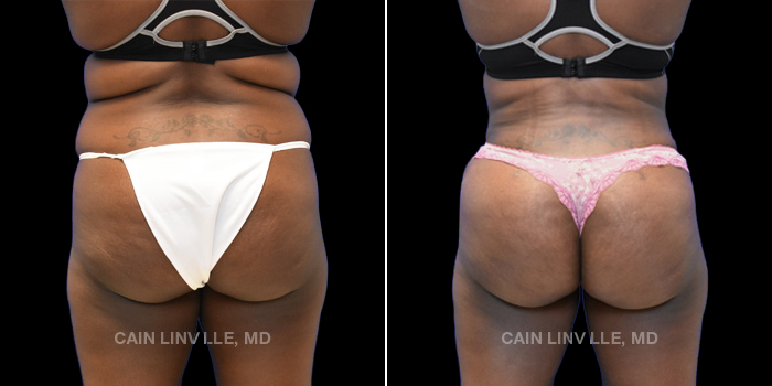 40 year old underwent tummy tuck with liposuction to abdomen and flanks. Brazilian buttock lift with 470 cc injected on each side to improve projection and shape.