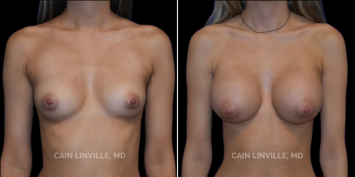 Patient 14 Front View Breast Augmentation Linville Plastic Surgery