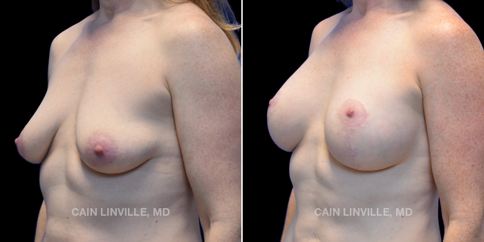 This patient is a 44 year old female who received a breast lift with implants. These photos are 1 year post op.