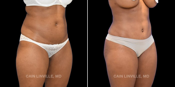 34-year-old underwent mini tummy tuck, liposuction to abdomen, flanks, back, bra area, and outer thighs with bodytite. Fat grafting to buttocks of 450 cc injected on each side for more volume and shape. Breast Augmentation of 485cc silicone smooth cohesive implants.