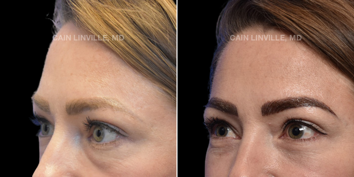 This patient is a 32 year old female who received a lower Blepharoplasty. These photos are 6 months post op.