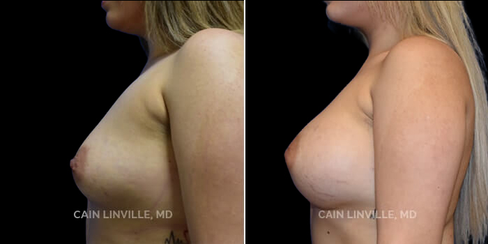 Patient 15 Left Side View Breast Augmentation Linville Plastic Surgery