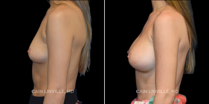 Patient 16 Left Side View Breast Augmentation Linville Plastic Surgery