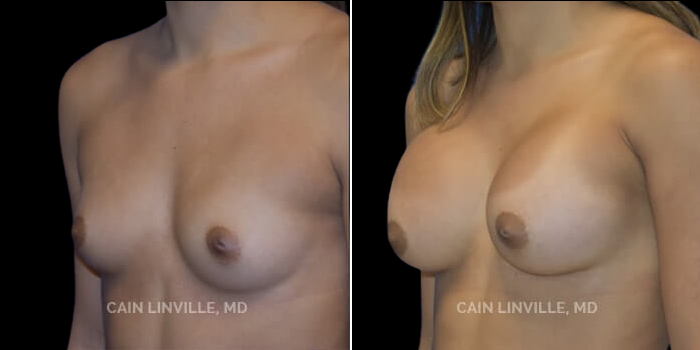 Patient 17 3/4th Right Side View Breast Augmentation Linville Plastic Surgery
