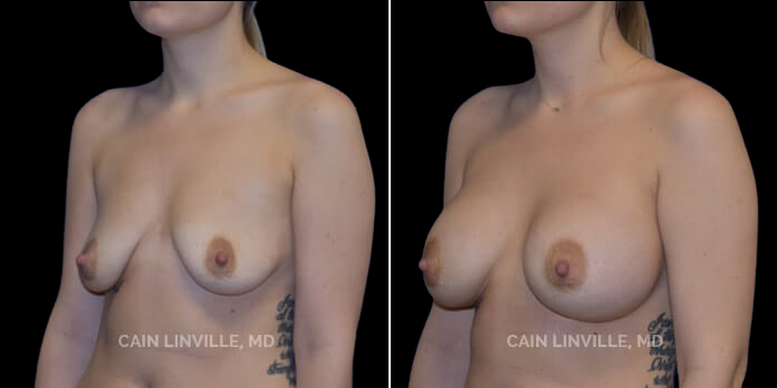 Patient 18 3/4th Left Side View Breast Augmentation Linville Plastic Surgery