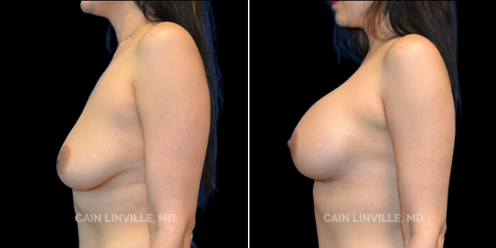 Patient 19 Left Side View Breast Augmentation Linville Plastic Surgery