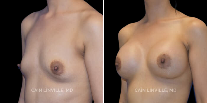 This young woman desired an increase in size from a very small A cup to a full C cup, but wanted to maintain a look that suited her body and still looked natural. Also, she is young and has not had children yet, so an inframammary incision was chosen to avoid the breast tissue and preserve nipple sensation and her ability to breastfeed. 445 cc responsive silicone implant, dual plane 0.5 pocket, inframammary incision. These pictures at 6 months show perfect implant position and the ultimate transformation from minimal breast tissue to a perfect figure. The implants also fit her petite frame because their projection is extra full which minimizes any widening of the chest. If anything, her results will mature and look more natural over time.