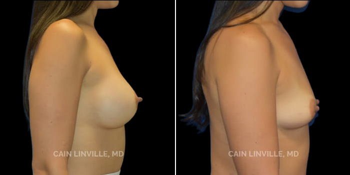 Patient 21 Right Side View Breast Augmentation Linville Plastic Surgery