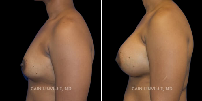 Patient 22 Left Side View Breast Augmentation Linville Plastic Surgery