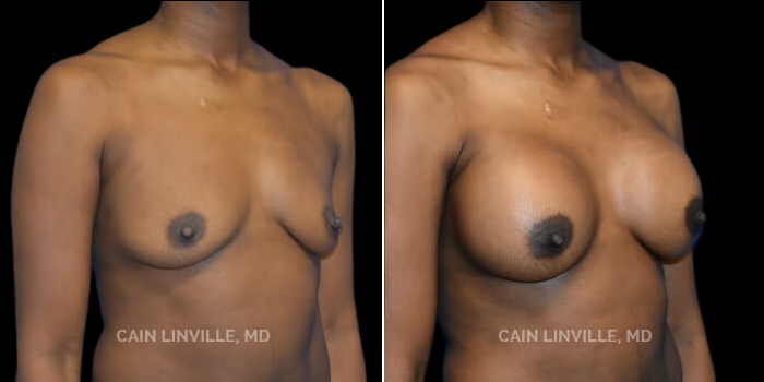 Patient 23 3/4th Left Side View Breast Augmentation Linville Plastic Surgery