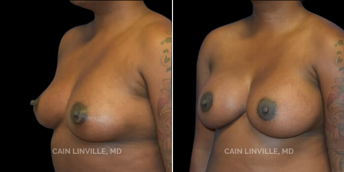 Patient 24 3/4th Left Side View Breast Augmentation Linville Plastic Surgery