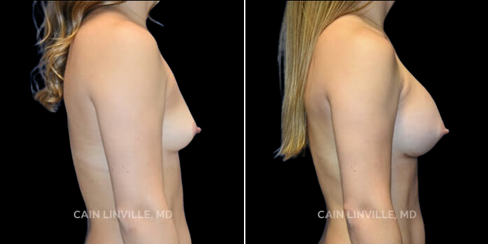 Patient 25 Right Side View Breast Augmentation Linville Plastic Surgery