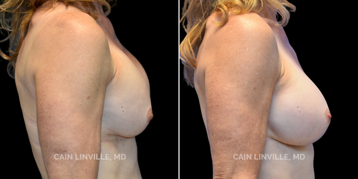 This patient is a 61 year old female who received a breast implant exchange to achieve a more natural and full appearance. These photos are 1 year post op.