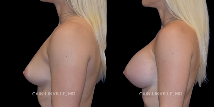 This young woman wanted a full-round look that didn’t need a bra’s support to achieve enhanced cleavage. Her desired increase in size was to go from a B cup to a full D cup. 420 cc highly cohesive silicone implant, dual plane 0.5 pocket, inframammary incision. At 33, she now has the full chest look she wanted that goes well with her frame. Thehighly cohesive implants gave her the roundness and cleavage she’s always wanted while maintaining a natural but augmented look.