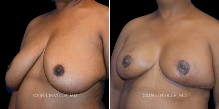 Patient 04 3/4th Left Side View Breast Reduction Linville Plastic Surgery
