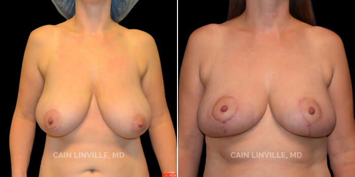 Patient 02 Front View Breast Reduction Linville Plastic Surgery