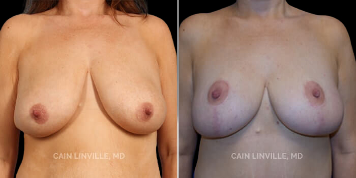 Patient 01 Front View Breast Reduction Linville Plastic Surgery