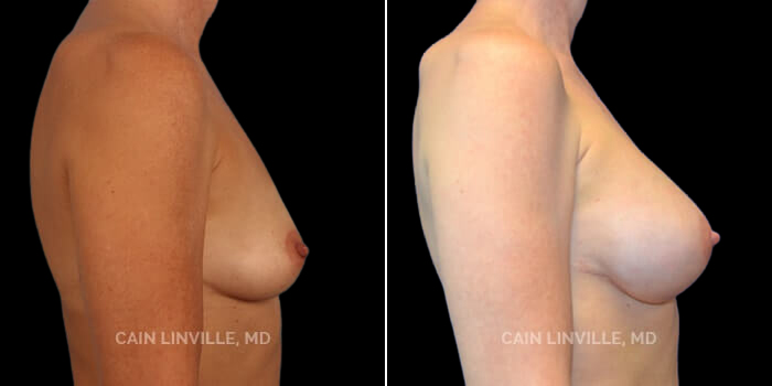 50 yo woman underwent bilateral mastectomy, with b/l Tissue expanders and then placement of permanent implants, with fat grafting. She initially had lateralization of the nipples, which was corrected by rotating the breast medially. She had anatomic implants along with fat grafting, and has a perfect contour and shape afterwards. In fact, she secretly always wanted to be bigger, and this was able to be achieved by the use of the expanders after surgery.
