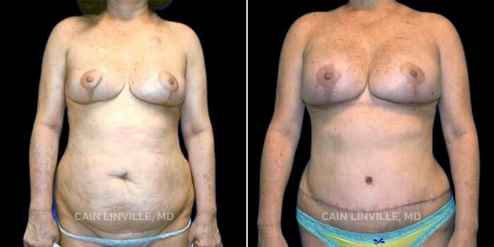 55 yo woman who underwent the new Three-Stage breast reconstruction, specifically used to reconstruct the ptotic breast. She initially had a lumpectomy with an oncoplastic breast reduction, which removes the tumor and lifts the breast and nipple-areola complex. Next, she had bilateral nipple-sparing mastectomies and simultaneous DIEP flap breast reconstruction. The third stage is simply a revision of her results (resection of skin paddle, fat grafting), and leaves her with a mommy-makeover look, where it appears as if she’s had a mastopexy and tummy tuck. She recently underwent another small revision to help with a couple of small issues and we will post her follow-up pics in a few months.