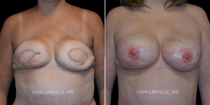 This 45 yo woman underwent bilateral mastectomies and immediate DIEP flaps, which is depicted in her pre-op photos (her pre-op pictures are missing!). This is a good example, however, of the contour problems that can be seen after DIEP flaps due to the skin flaps overlying them being thin – she just had a mastectomy. Her postop pictures though, show how filling in the tissue with fat helps to blend in and erase those contour problems creating a very nice natural result. She also recently had a very small revision in order to enhance her symmetry, and her results are even better than shown here. We will post those pictures in just a few months. Also note, her nipples were created via surgery, and then she had 3-D tattooing which looks uber-natural.