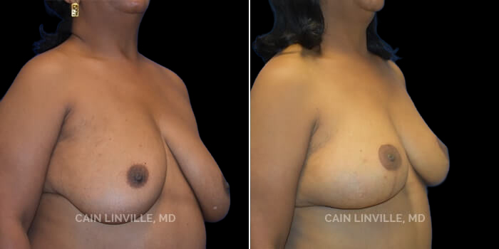 60 yo woman who underwent 3-stage reconstruction. Preoperatively, she had significant breast ptosis, but was a nipple-sparing candidate otherwise. Thus, she had a lumpectomy, with bilateral oncoplastic reduction. Next she had bilateral nipple-sparing mastectomies, and simultaneous DIEP flaps for reconstruction. Lastly, she had a revision, with fat grafting. Her end result is identical to a mastopexy, but instead what is under her breast skin envelope is her previous abdominal tissue! Her scar result, mimicking a mastopexy and tummy tuck, is phenomenal, and she is extremely happy.
