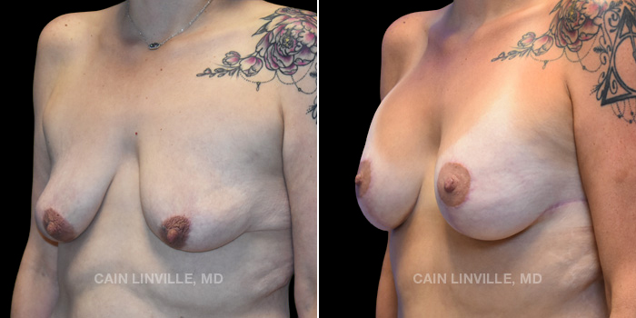 36 year old female who received a breast lift with implants. These photos are 6 months post op.
