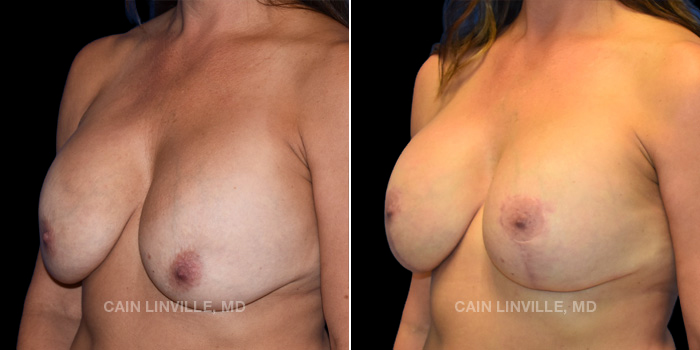 This 54 year old patient wanted a fuller and more lifted appearance to her natural breast. We did a mastopexy with placement of implants. These photos are 1 year post op.