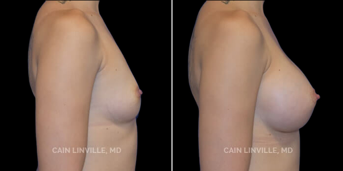 This young 24 year old woman desired an increase in size that wouldn’t make her chest too wide due to her petit frame. She wanted to go from a B cup to a full C cup for enhanced roundness and volume. 375 cc highly cohesive silicone implant, dual plane 0.5 pocket, inframammary incision. The implants gave her enhanced projection which allowed for an increase in volume without excessive widening of the chest. This augmentation method helped to achieve the look she dreamt of.