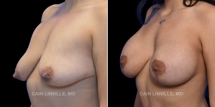 Patient 12 3/4th Left Side View Breast Lift Linville Plastic Surgery
