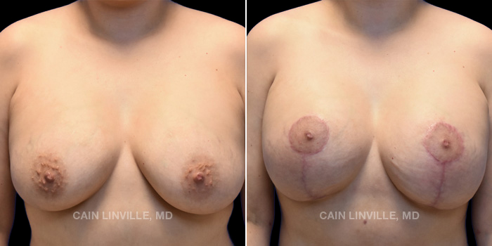 Patient 11 Front View Breast Lift Linville Plastic Surgery