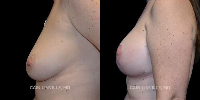 Patient 1 Left Side View Breast Lift Linville Plastic Surgery