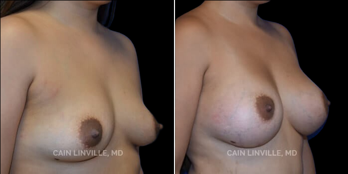 This young mother had breast asymmetry and sought out augmentation to give her an increase in size and correction of her asymmetry. She wanted to maintain a natural look while enhancing size and symmetry. 340 cc responsive gel round implant, dual plane 0.5 pocket, inframammary incision. 200 cc of fat second stage back grafting. Utilizing both responsive gel and fat from back grafting, she was able to achieve a more natural appearance. Her result gave her a natural slope, increase in volume, and symmetry that she wanted.