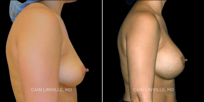 Patient 09 Left Side View Breast Augmentation Linville Plastic Surgery