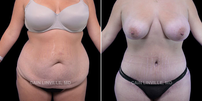 This patient is a 38 year old female who received a tummy tuck, liposuction 360, and bodytite. These photos are 4 months post op.