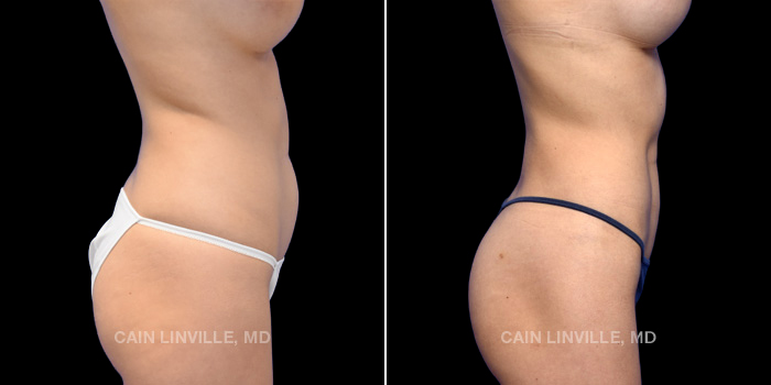 This patient is a 22 year old female who received abdominal etching through liposuction to her abdomen, flanks, and back with fat grafting to her buttocks (mini BBL). These photos are 6 months post op.