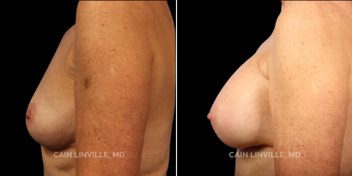 Patient 10 Left Side View Breast Augmentation Linville Plastic Surgery
