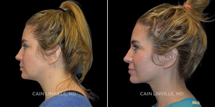 This young woman desired an improved, rejuvenated appearance of her submental contour and face. FaceTite to the neck and lower face, along with submental lipo, and fat grafting to the cheeks, lower lids, and temples was performed to achieve a very natural look with an ideal neck contour. This was all done with the patient awake, and was well-tolerated. The enhanced cheek contour along with improved neckline and contour give an extreme but natural change in appearance.