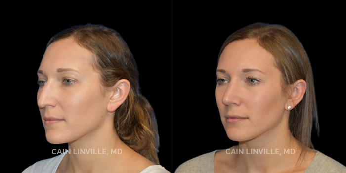 Patient 01 3/4th Left View Rhinoplasty Linville Plastic Surgery
