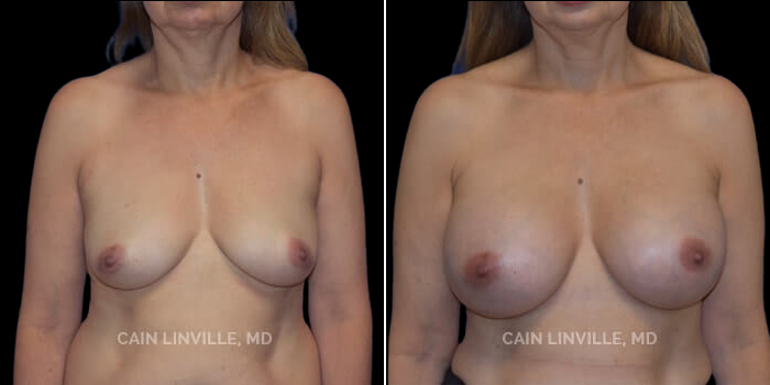 Patient 13 Front View Breast Augmentation Linville Plastic Surgery