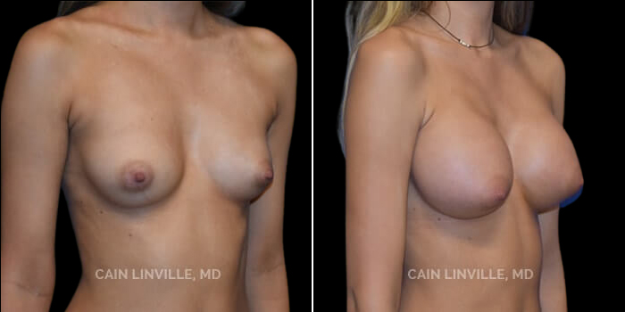 Patient 14 3/4th Right Side View Breast Augmentation Linville Plastic Surgery