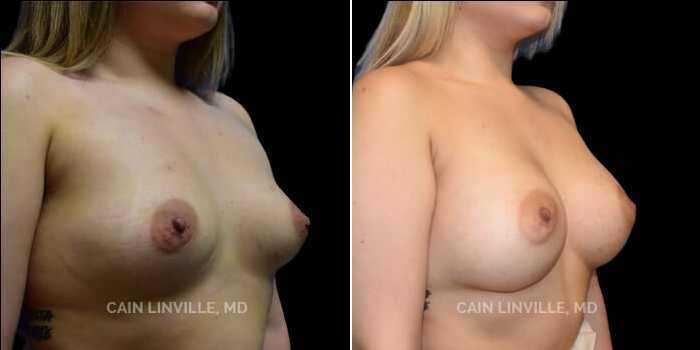 Patient 15 3/4th Right Side View Breast Augmentation Linville Plastic Surgery
